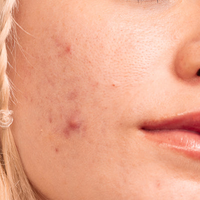 everything you need to know about acne scarring