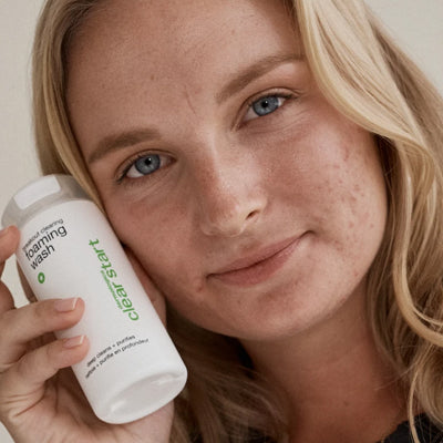teenage acne sucks. here’s how to fix it