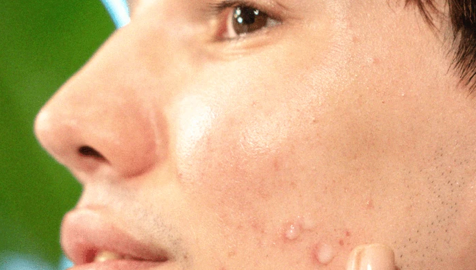 the best ingredients for acne prone skin