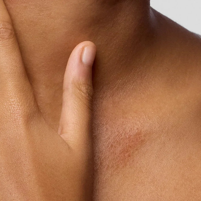 Eczema-prone skin? these daily habits can help reduce flare-ups