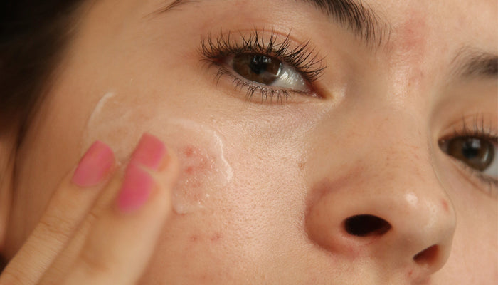 what are acne-causing ingredients?