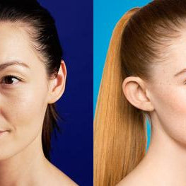 the difference between adult acne and teen acne
