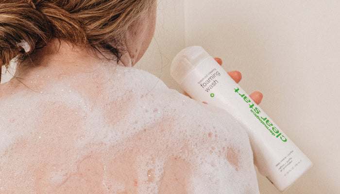 what is the difference between pimples and acne?