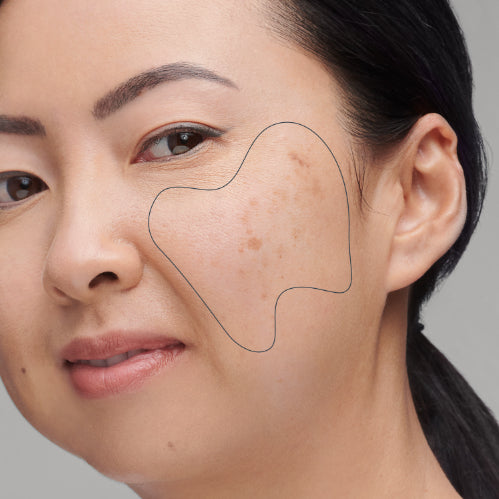 What causes uneven skin tone?