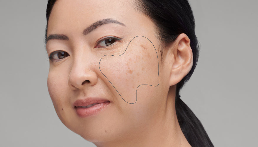 What causes uneven skin tone?