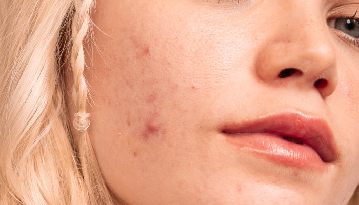 everything you need to know about acne scarring