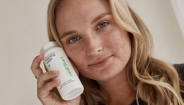teenage acne sucks. here’s how to fix it